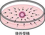 コンベンショナルIVF